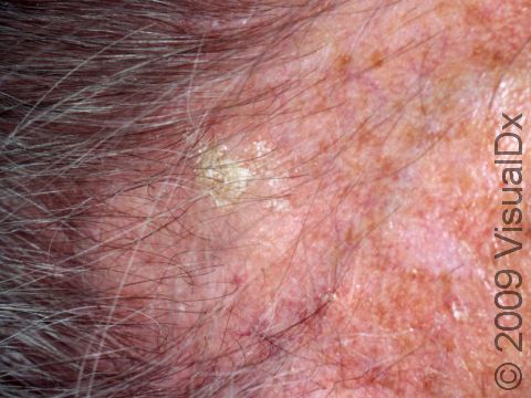 This image displays a thin white scale typical of actinic keratosis.