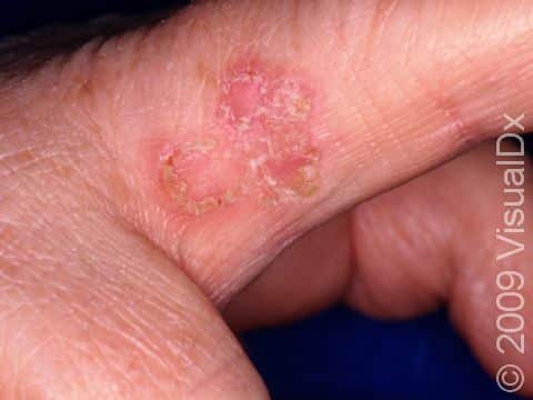 This image displays an actinic keratosis in an unusual location, the side of the finger.