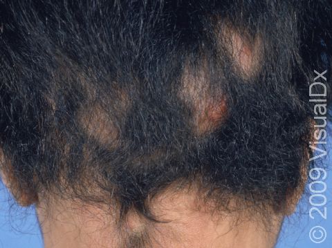 This image displays a patient with alopecia areata that has had some spontaneous regrowth, covering many of the areas of hair loss.