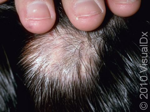 This image displays a round area of hair loss with fine regrowth due to alopecia areata.