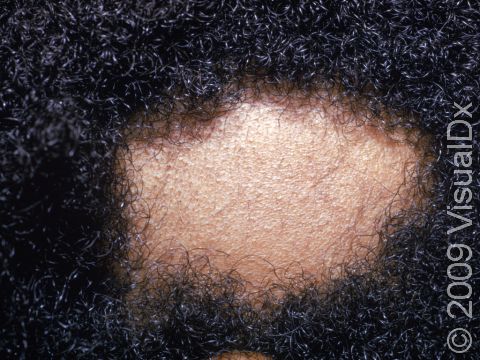This image displays hair follicles that are still present with some starting to regrow hair with slender, short stubs.