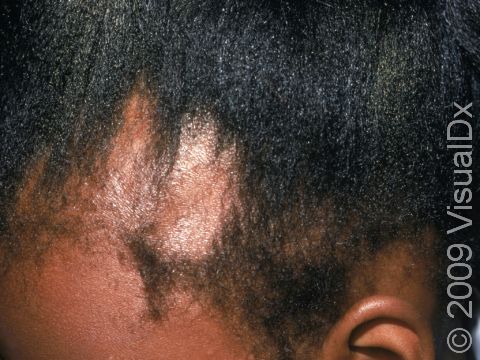 This image displays a child with multiple areas of hair loss: behind the ear, at the frontal hairline, and the front part of the scalp.