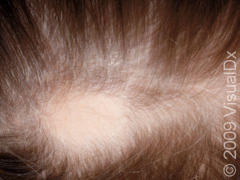 The skin where the hair is gone in alopecia looks completely normal.