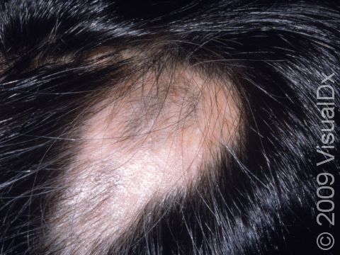 This image displays hair regrowing as is typical with alopecia areata.