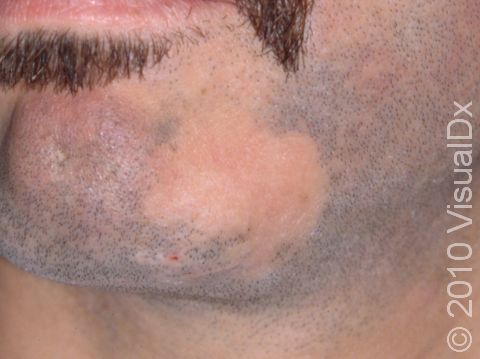 Alopecia Areata-Hair loss with small Oval patches on Scalp