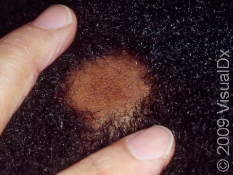 A round area of non-scarring hair loss due to alopecia areata.