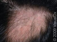 Hair Loss (Alopecia Areata) – Adult