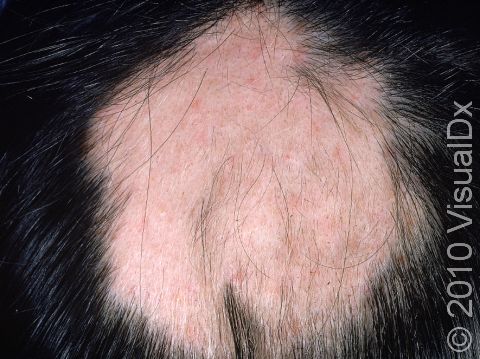 This image displays a circular area of hair loss, with no redness or scarring of the scalp, typical of alopecia areata.