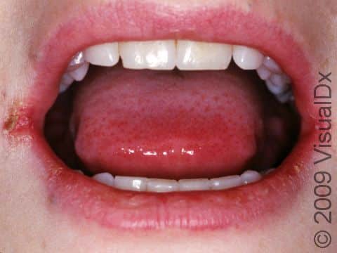 The cracking at the corners of the mouth in oral candidiasis, as displayed in this image, is known as angular cheilitis or perl?he.