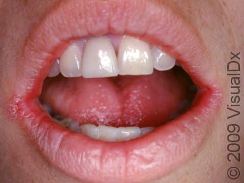 This image displays cracking and scaling at the corners of the mouth typical of angular cheilitis.