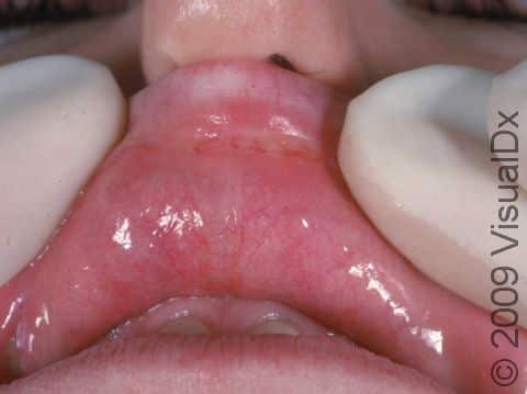 This image displays a shallow ulcer inside the mouth, typical of an aphthous ulcer (canker sore).