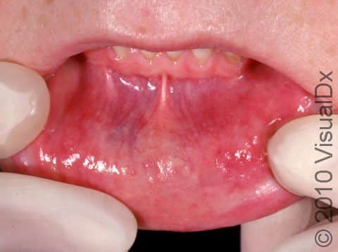 This image displays a shallow aphthous ulcer (canker sore).