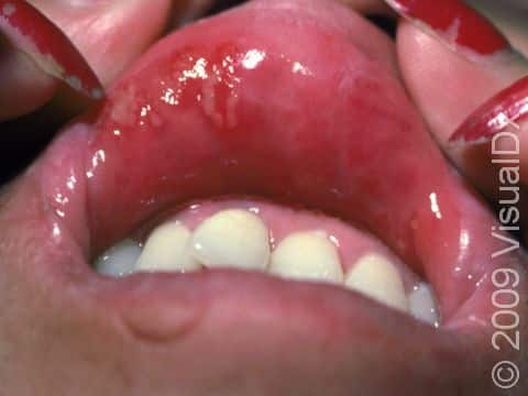 This image displays multiple aphthae (canker sores), lesions with a white center and red surround.
