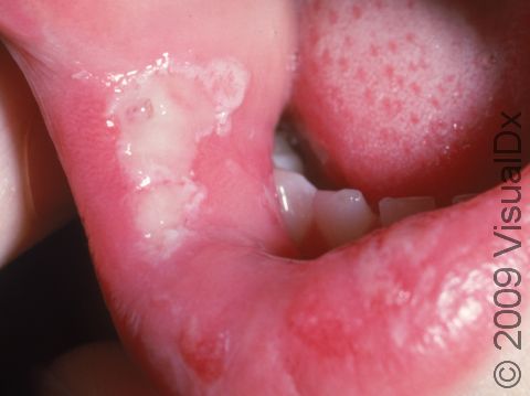 This image displays a larger-than-usual aphtha (canker sore), with the typical white erosion.