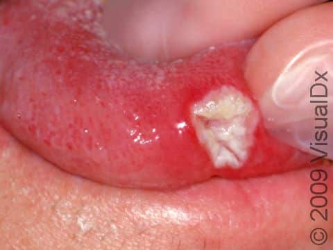 As displayed in this image, aphthous ulcers typically have a white or yellow color.