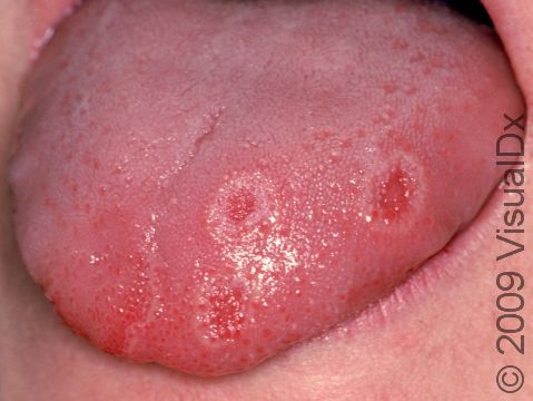This image displays a tongue with three small ulcers from aphthae.