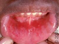 Canker Sore (Aphthous Ulcer)
