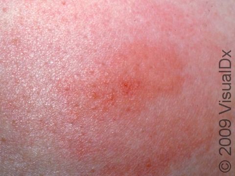This image displays a red/pink, round lesion typical of an insect bite.
