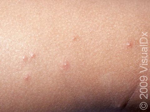 This image displays a child with small, pink bumps typical of insect bite reactions.
