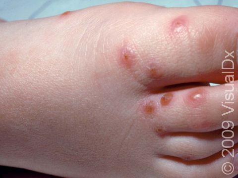 Insect bites often have small blisters that dry and crust.