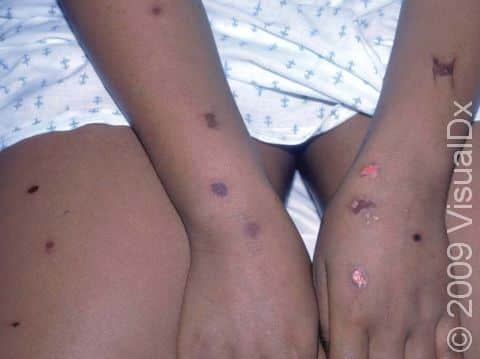 This image displays insect bites after several days of itching and scratching, causing them to look like abrasions.