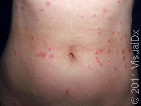 In severe bug assaults, numerous itchy red bumps appear at the same time. Note the tendency for the bumps to be grouped together, rather than evenly spread apart. 