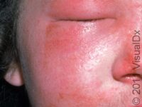 Itchy Bumps on the Skin in Children