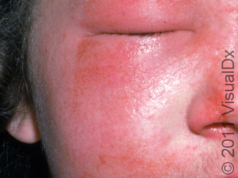 This image displays a severe reaction to an insect bite with eyelid and facial swelling.