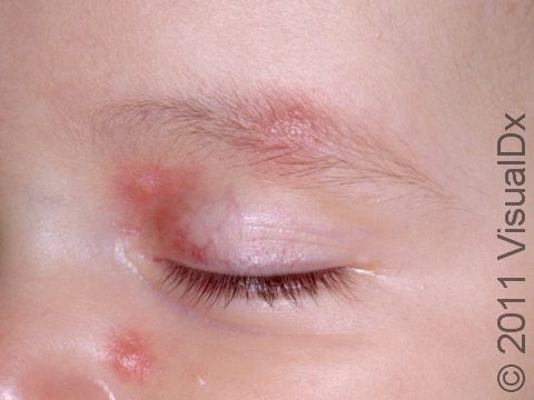 Bites often occur together over a small area of the body, such as these occurring near the eye.