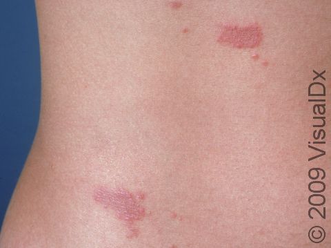 Insect bites or bug bites can cause localized redness and itching.