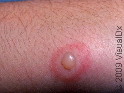 An insect bite can result in a blister.