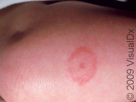 Bug bites or stings typically have a circular appearance, often with a central darker area at the site of the bite.