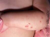 Bug Bite or Sting (Pediatric)