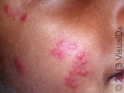 Bug bites often cause hive-like (urticarial), swollen lesions.