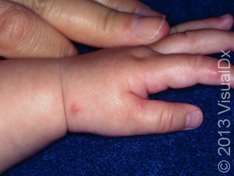 There are 3 typical insect bites displayed: one each on the finger and thumb and another near the wrist.