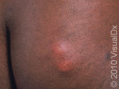 On people with darker skin, inflammation and redness from insect bites can appear as red-brown-colored lesions.