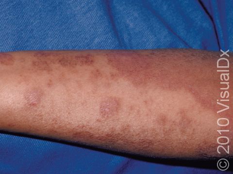 This image displays extensive atopic dermatitis (eczema); note the skin is dry and scaly, which is typical of atopic dermatitis.
