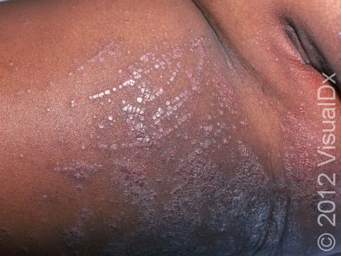 Atopic dermatitis (eczema) in patients with darker skin often has prominent, small bumps that join to form larger areas of dry, scaling skin.