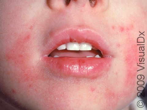 Atopic dermatitis (eczema) frequently affects the face in children. Look for red or pink scaling areas and dry-appearing skin.