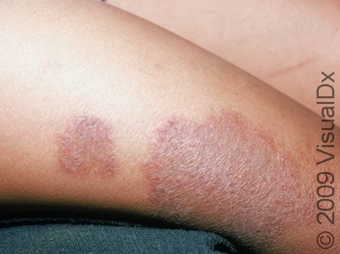 Atopic dermatitis (eczema) that has been present for an extended period of time begins to looks thickened and darker.