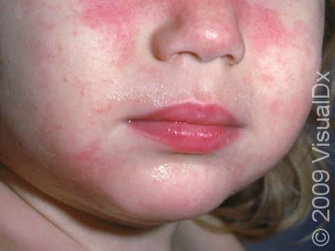Atopic dermatitis (eczema) can involve the face and scattered body areas, as in this child.