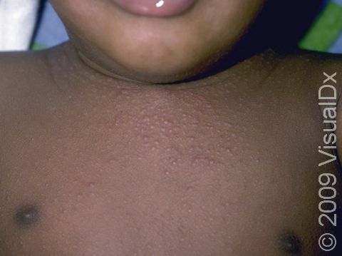 In atopic dermatitis (eczema), the rash often has a pattern following the hair follicle.