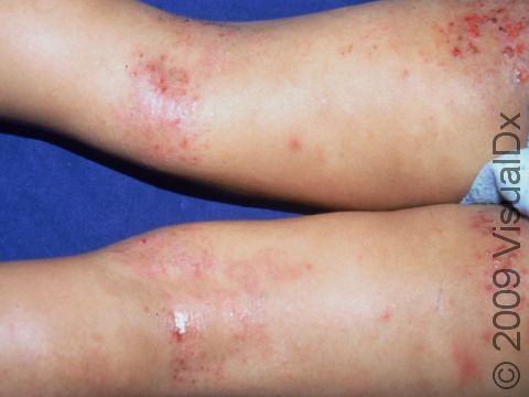 This image displays atopic dermatitis (eczema) on the back of the legs with erosions from scratching.