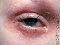 Chronic Itchy Skin Rashes in Children