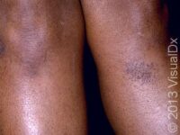 Eczema (Atopic Dermatitis) – Teen