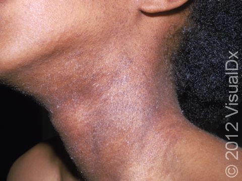 This image displays the typical scaly and slightly pink lesions of atopic dermatitis (eczema) in a teenager.