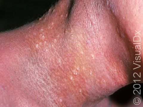 This image displays atopic dermatitis (eczema) with thickened skin and small bumps due to chronic rubbing.