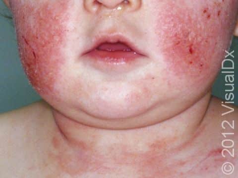 This image displays symmetric scaling, red, slightly elevated lesions typical of atopic dermatitis (eczema).