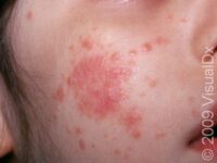 Eczema (Atopic Dermatitis)