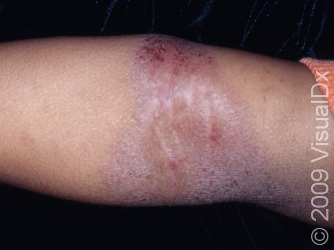 Atopic dermatitis (eczema) typically involves the folds of the elbows and knees (flexures) in children.